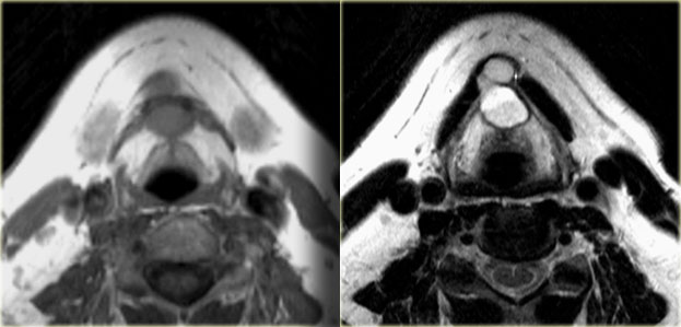 Thyroglossal duct cyst: axial T1- and T2-weighted images at the level of the hyoid bone