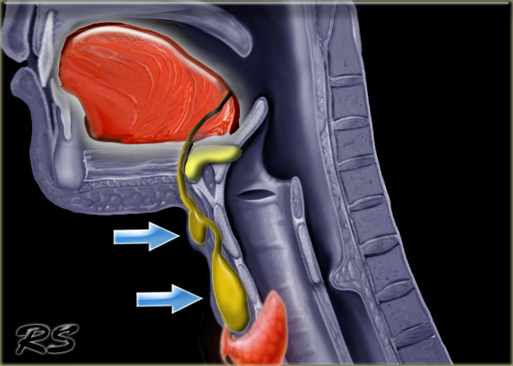 The Radiology Assistant Infrahyoid Neck