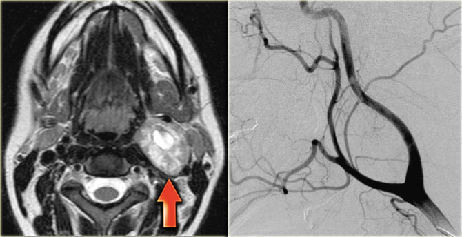 Schwannoma: axial T2-weighted image and angiogram