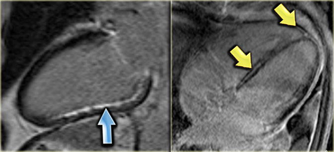 LEFT: Long axis late enhancement image in a patient with an inferior wall infarction with subendocardial enhancement in the territory of the right coronary artery RIGHT: 4-chamber late enhancement image in a patient with idiopathic dilated cardiomyopathy with midmyocardial enhancement