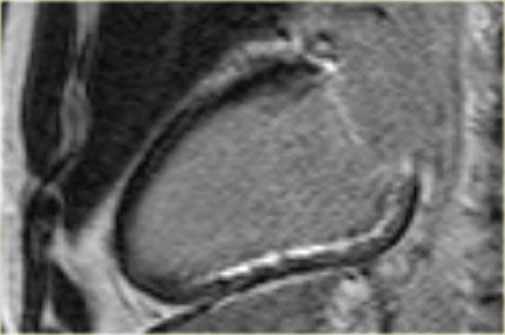 Long axis late enhancement image  6 days after  revascularized acute inferior wall infarction