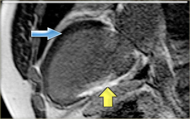 Hibernation of the anterior wall (blue arrow) and old transmural inferior wall infarction (yellow arrow).