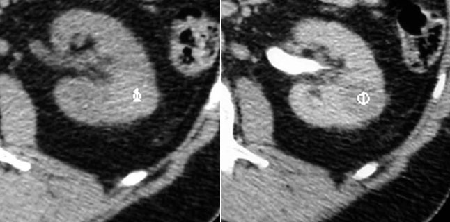 Significant enhancement: Unenhanced CT: 44 HU (left)Enhanced scan: 61 HU (right) ..... Excise
