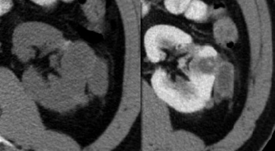 Enhanced CT shows enhancement of a thick wall and a central area.....excise