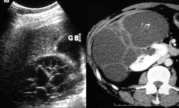 Multiloculated cystic mass on US and on CT..... Excise