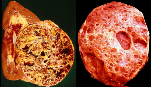 Multilocular renal cell carcinoma (left) and a multilocular cystic nephroma (right)