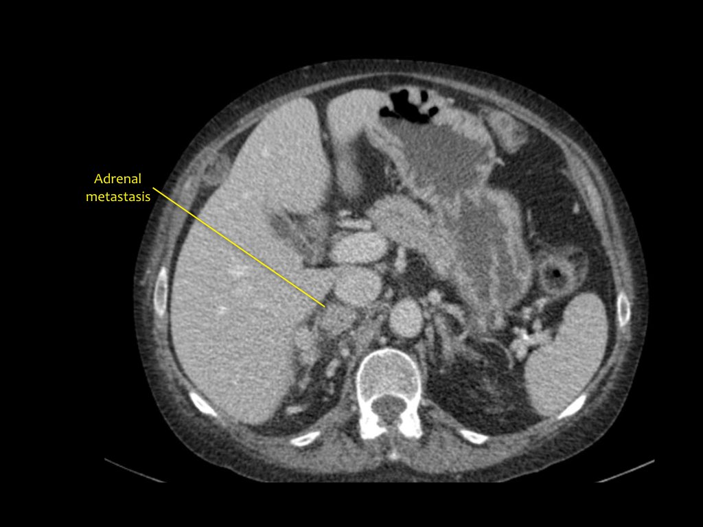 The Radiology Assistant Kidney Solid masses