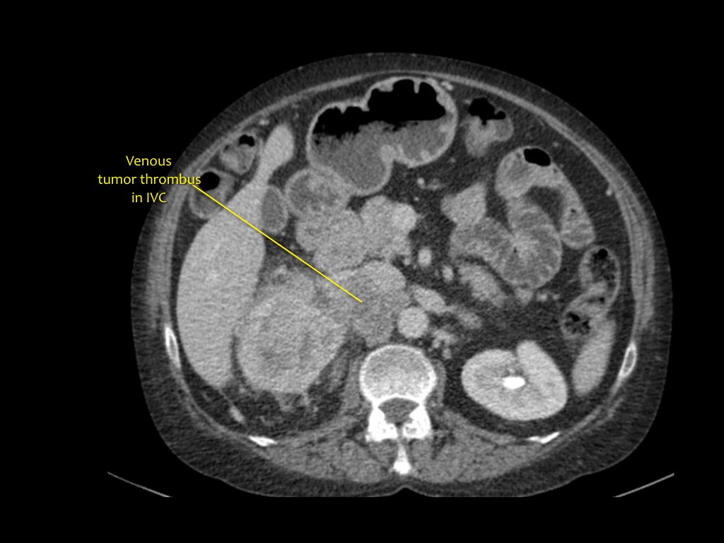 Kidney Mass Ct Scan