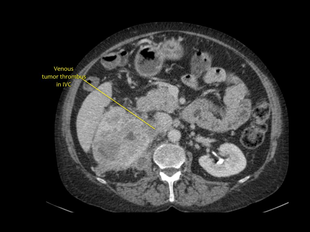 laser-lithotripsy-laser-treatment-of-kidney-stones