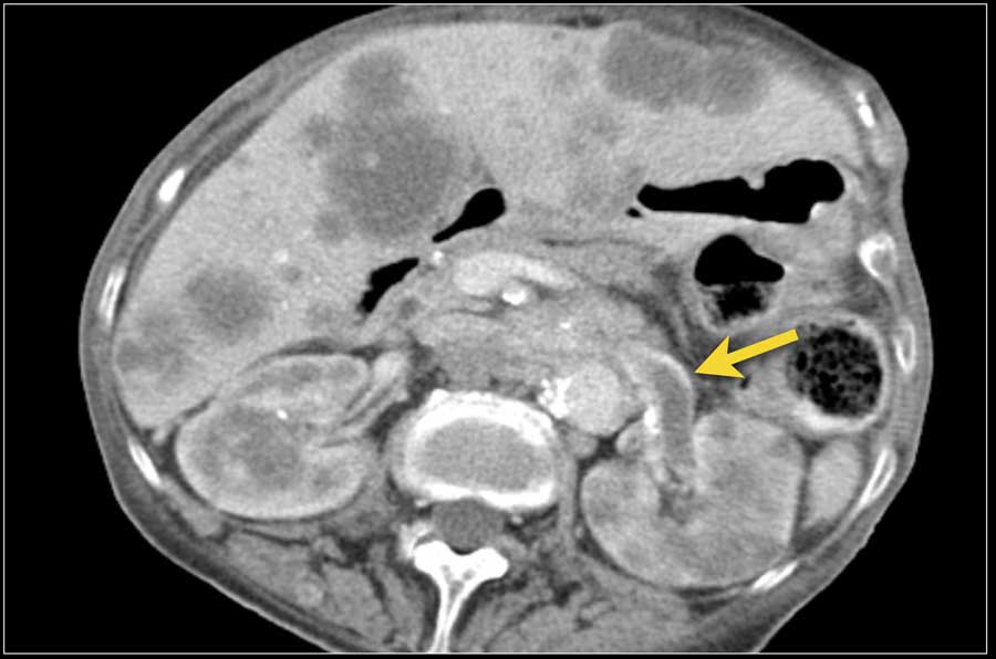 Multiple liver and renal metastases. Thrombus in the left renal vein (arrow).