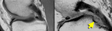 LEFT: normal medial meniscal root immediately anterior to the posterior cruciate ligament. RIGHT: missing posterior root due to meniscal root tear.