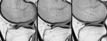 Lateral meniscus.  Both horns are about the same size.