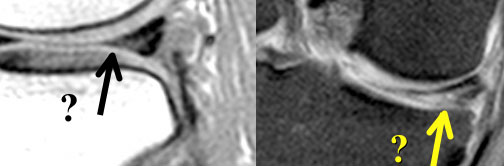 High signal intensity not unequivocally contacting surface. Small black line on inferior margin of the meniscus. At arthroscopy the meniscus was normal.