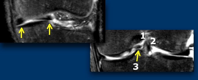 LEFT: meniscus is abnormal in shape and there is a displaced fragment. RIGHT: Three structures in the intercondylar fossa: post cruciate lig (1), ant cruciate lig (2) and displaced fragment (3).