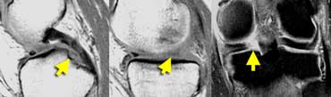 Meniscal root tear: on sagittal images there is an absent or empty meniscus-sign adjacent to the posterior cruciate ligament where the meniscal root should be. On coronal images a meniscal root tear is confirmed.
