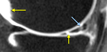 MR-arthrogram: In the new tear the signal is as bright as in the synovial fluid (yellow arrows). In the healed tear the signal is not as bright.