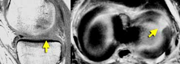 LEFT: Absent or empty meniscus on sagittal image. RIGHT: Axial image shows complete radial tear leading to a defect in the meniscus.