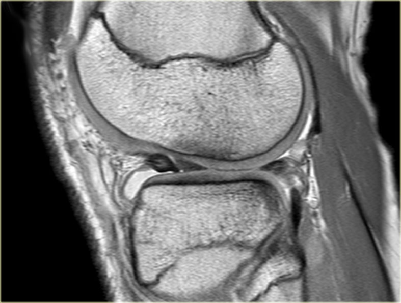 Повреждение мениска коленного сустава по stoller