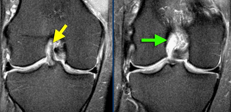 LEFT: ACL-fibers have a normal orientation but do not connect to femurcondyle. RIGHT: Empty notch sign: fluid against the interior part of the lateral condyle