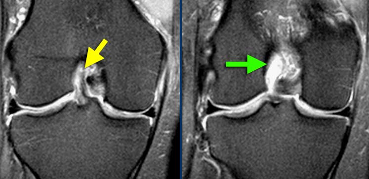 anterior cruciate ligament mri