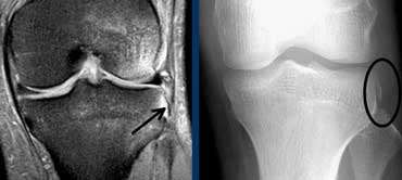 Segond fracture indicating ACL-tear