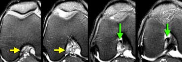 In the axial plane there is an empty notch sign (yellow arrows) where there should be ACL attached to the condyle. At a lower level (going right) the torn ACL is scarred to the PCL (green arrows)
