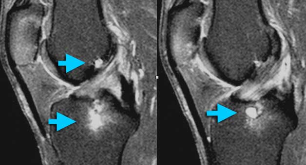 ACL Mucoid degeneration with cyst-formation (intra-osseus ganglion). Mucoid material is squeezed from between the ACL-fibers into the bone. At arthroscopy ACL and bone looked normal.
