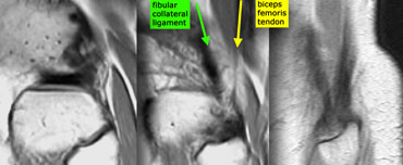 Posterolateral corner anatomy from medial to lateral on sagittal images. Fibular collateral ligament (green)  and Biceps femoris tendon (yellow) form a letter V and insert as conjoined tendon on fibular head.