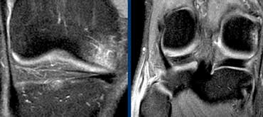 LEFT: bone bruise anteromedial. RIGHT: biceps femoris tendon is not attached to the fibula.