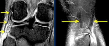 LEFT: distal rupture of fibular collateral ligament.RIGHT: biceps femoris tendon and collateral ligament do not attach.