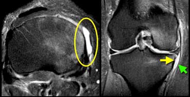 Medial collateral ligament bursitis located between the deep MCL (yellow arrow) and the superficial MCL (green arrow).