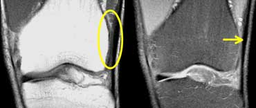 Iliotibial Band Friction syndrome: no fat between iliotibial band (yellow arrow) and the lateral condyle.