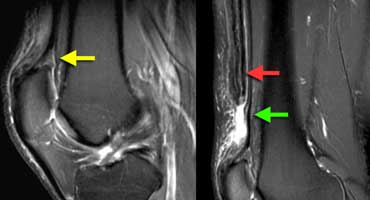 Partial quadriceps tendon tear: T2W-images.LEFT: Abnormal attachment of tendon.RIGHT: Most of tendon is retracted (red arrow) deep part (vastus intermedius) is still intact.