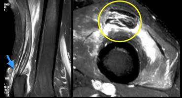 LEFT: Partial quadriceps tear. Only rectus femoris tendon is torn (blue arrow). RIGHT: Pre-existing tendinopathy (yellow cirkle) on axial image.