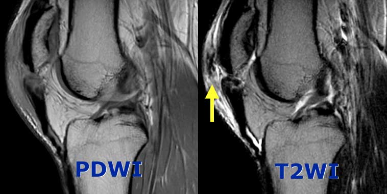 Complete Patellar tendon tear. Image on the right shows hemorrhagic bursitis ( low signal in bursa).