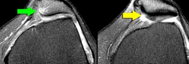 LEFT: Bone bruise medial patella (green arrow).RIGHT: Cartilage fracture.