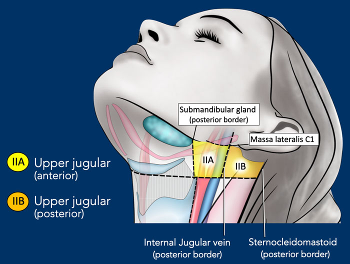 The Radiology Assistant : Cervical Lymph Node Map