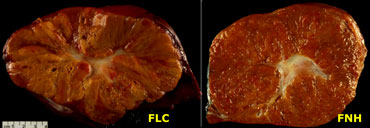 Pathologic specimen of FLHCC and FNH (Courtesy Dr. Baron)