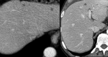 Contrast enhanced CT (portal phase) showing multiple small hypodense lesions.