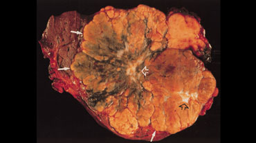 Left-lobe fibrolamellar HCC. Courtesy Dr. Federle and Dr. Ichikawa (3)