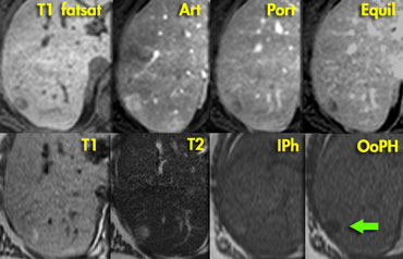 Adenoma: capillary blush in arterial phase and signal loss in out of phase image indicating the presence of fat.