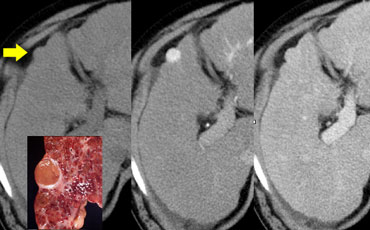 Small Hepatocellular carcinoma in cirrhotic liver not visible on NECT (left), clearly visible in arterial phase (middle)  and not visible in portal venous phase (right)