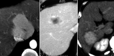 Detection of a lesion depends on difference in attenuation between liver and lesion.LEFT: Arterial phase showing hypervascular FNHMIDDLE: Portal venous phase showing hypovascular metastasisRIGHT: equilibrium phase showing relatively dense cholangiocarcinoma