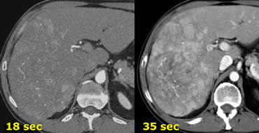 CT of the liver in the early arterial phase (left) and the late arterial pase (right).