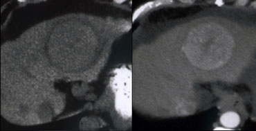 NECT and Arterial phase image showing hypodense capsule of HCC