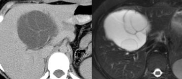 CT and T2W MR-image of echinococcus cyst.