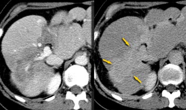 Hepatic and delayed phase in a patient with breast metastases causing retraction of liver capsule. Notice delayed enhancement of the fibrotic tissue (arrows)