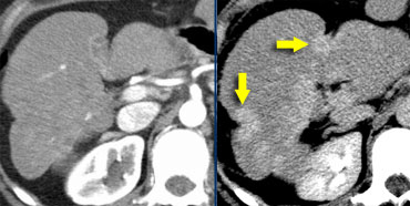 Hepatic and delayed phase in a patient with multifocal cholangiocarcinoma causing retraction of liver capsule.