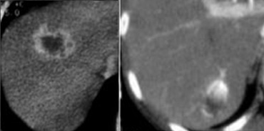 LEFT: rim enhancement in metastasis. RIGHT: hemangioma with discontinuous nodular peripheral enhancement