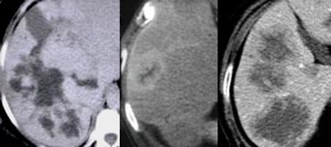 Progressive fill in in a hemangioma (left), cholangiocarcinoma (middle) and metastases (right).
